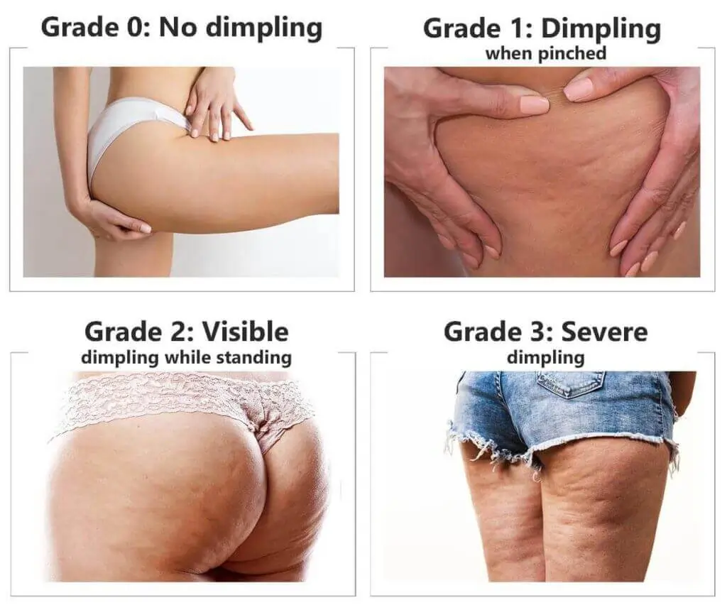 Representation of the stages of cellulite development Horley